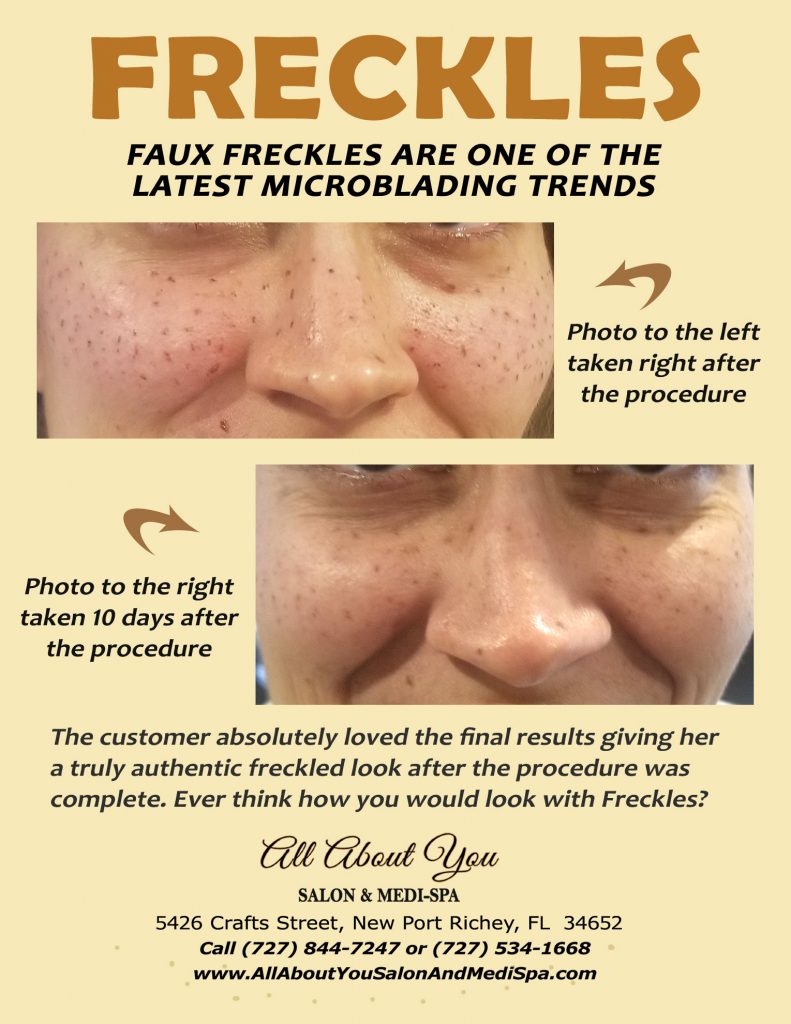 Freckles - Are they for you?